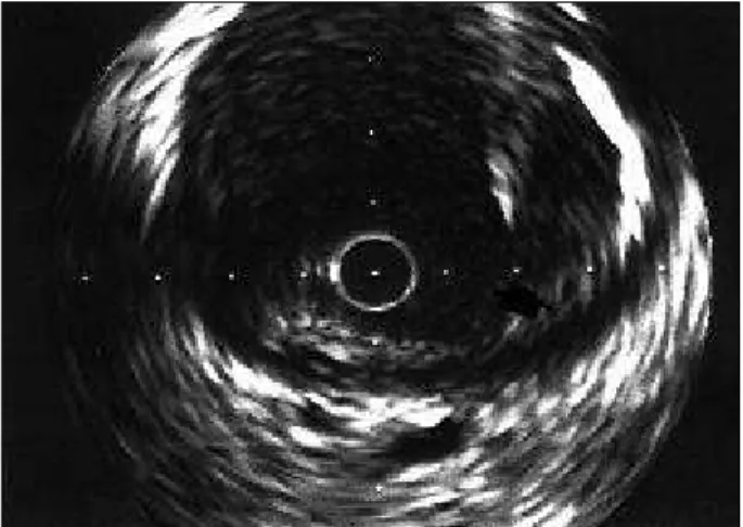 Fig. 5 – Placa mista. Observa-se material eminentemente lipídico contido por uma delgada capa fibrótica (seta).