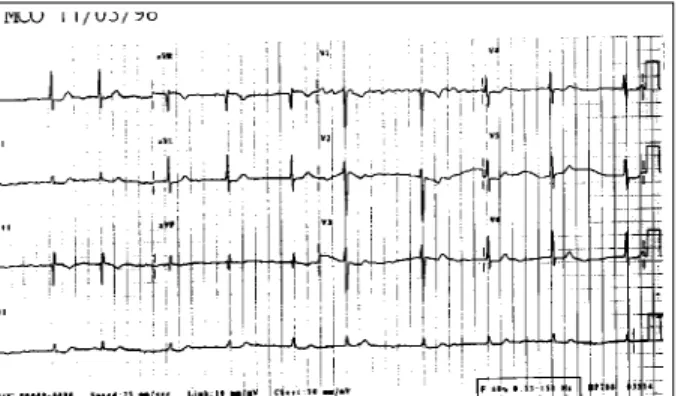 Fig. 1 - Eletrocardiograma - fibrilação atrial, sinais indiretos de sobrecarga atrial di- di-reita (Peñaloza- Tranchesi).
