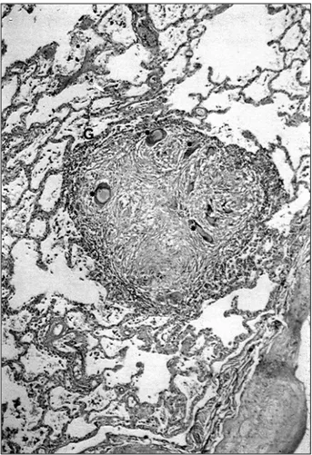 Fig. 3 - Meninge: micobacteriose. Presença de inúmeros bacilos álcool-ácido resis- resis-tentes (setas) em meio ao infiltrado inflamatório misto