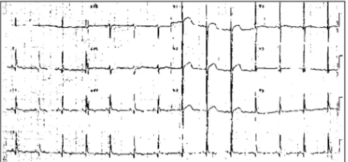 Fig. 1 - Electrocardiogram of one Friedreich’s ataxia patient with ventricular repolarization abnormalities and ventricular hypertrophy.