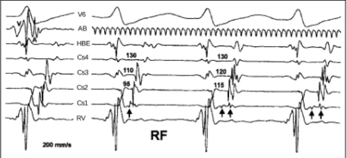 Fig. 1 - Tracings obtained during supraventricular tachycardia. Pictured are ECG recordings from surface lead V6, ablation catheter (AB), His bundle electrogram (HBE), proximal coronary sinus (Cs4), coronary sinus 3 (Cs3), coronary sinus 2 (Cs2), distal co