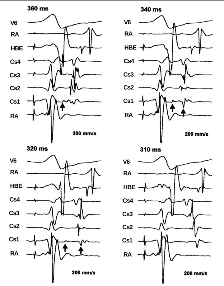 Fig. 2 - Tracings obtained during incremental pacing of the left ventricle. Shown Pictured are ECG recordings from surface lead V6, right atrium (RA), His bundle electrogram (HBE), proximal coronary sinus (Cs4), coronary sinus 3 (Cs3), coronary sinus 2 (Cs