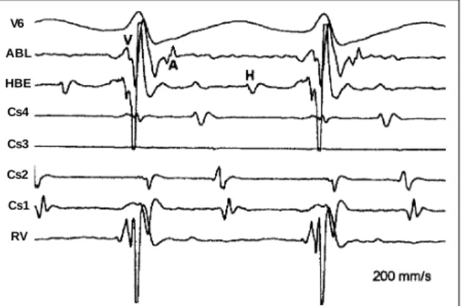 Fig. 3 - Atrioventricular tachycardia induction after left ventricular incremental pacing