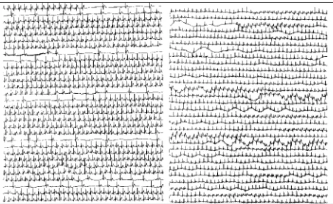 Fig. 4 - Continuous record showing trace before (A) and immediately after (B) introduction of temporary pacemaker showing control of bradyarrhythmia.