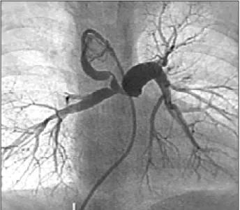 Fig. 1 - Artérias pulmonares centrais suprindo segmentos pulmonares de ambos os pulmões.