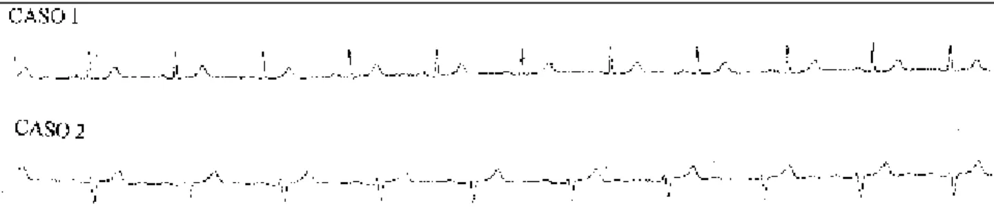 Fig. 4 - Record of the D 2  derivation of the electrocardiogram of the study patients, where the maintenance of the sinus mechanism can be observed, P waves of the same morphology and RR intervals without clear variations.