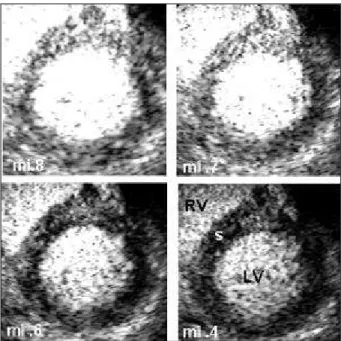 Fig. 3 – Normal pattern of myocardial perfusion: before (A) and after (B) adenosine bolus injection