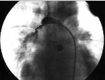 Fig. 3 - Adequate final location of the prosthesis after rescuing and repositioning. No residual shunt is present.
