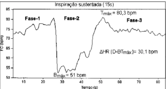 Fig. 1 - Effects of sustained inspiration (SI) on a series of RR intervals in an indivi- indivi-dual  in group I