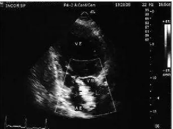 Fig. 5 - The preoperative transthoracic echocardiography evaluation of the dilated left ventricle.