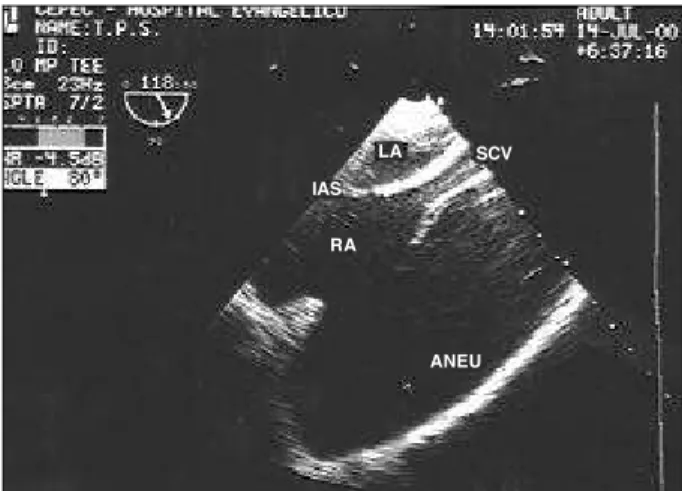 Fig. 1 - Transthoracic echocardiogram: aneurysm of the right atrial appendage produ- produ-cing compression of the right ventricle