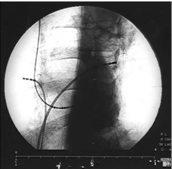 Fig. 6 – A left anterior oblique cine frame at a 30° position of the ablation catheter at the successful application site