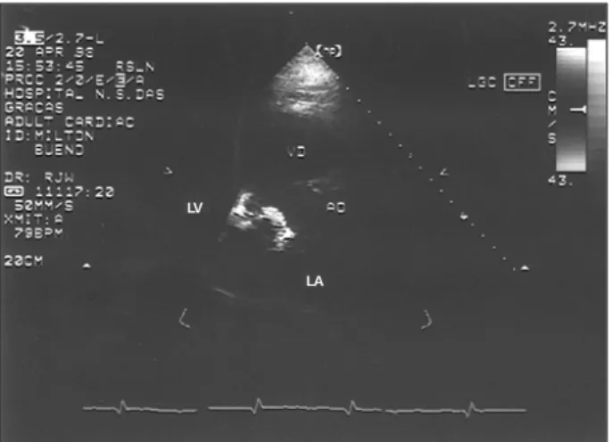 Table I – Echocardiographic data in the preoperative period, 1 and 7 days after surgery, and 2 years after surgery
