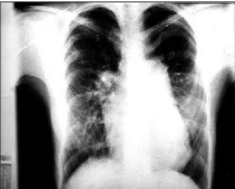 Fig. 1 - Radiografia de tórax mostrando aumento das cavidades direitas com ponta cardíaca elevada, arco médio abaulado e contraste da trama vascular pulmonar, mais saliente na parte hilar.