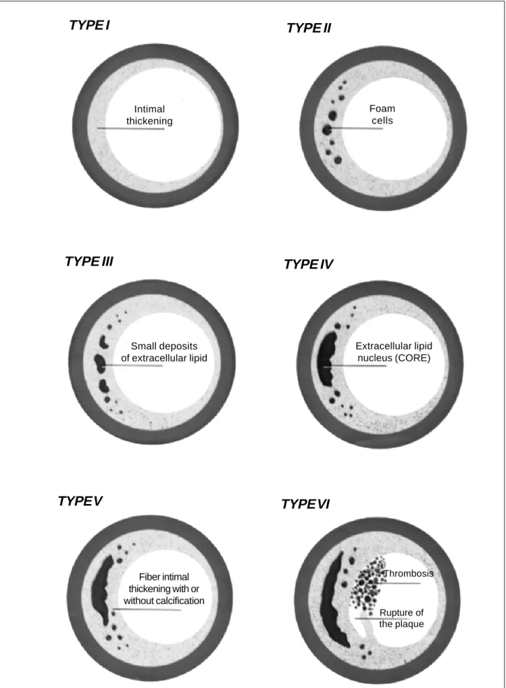 Fig. 1 - Histological types of atheromatous plaques, according to Stary. Source: Modified from Stary et al., Circulation 1995; 92:13461-62