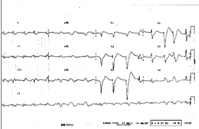 Fig. 1 - Eletrocardiograma - Bloqueio atrioventricular do 1º grau, sobrecarga atrial e ventricular esquerdas e alterações da repolarização ventricular.