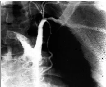 Fig. 1 - Angiografia em projeção ântero-posterior da artéria subclávia esquerda, evi- evi-denciando uma estenose severa no terço proximal antes da emergência da artéria  ma-mária interna esquerda.