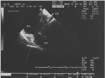 Fig. 1 - “Zoomed”  2-D image of the coronary sinus, from which the samples of flow were obtained