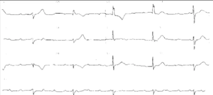 Fig. 1 - Electrocardiogram at admission: complete atrioventricular block with right bundle branch block morfology.