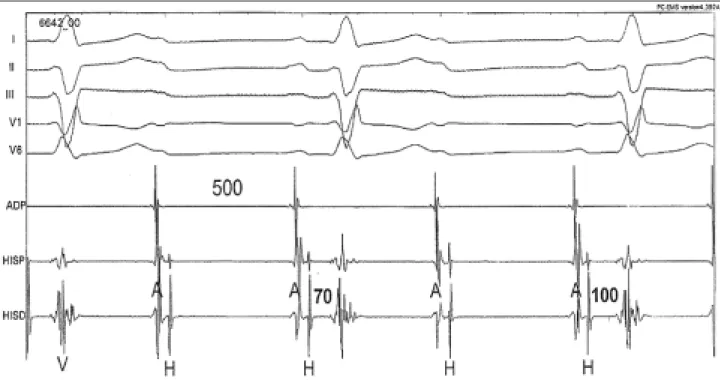 Fig. 3 - Electrophysiological study showing infra-His block.