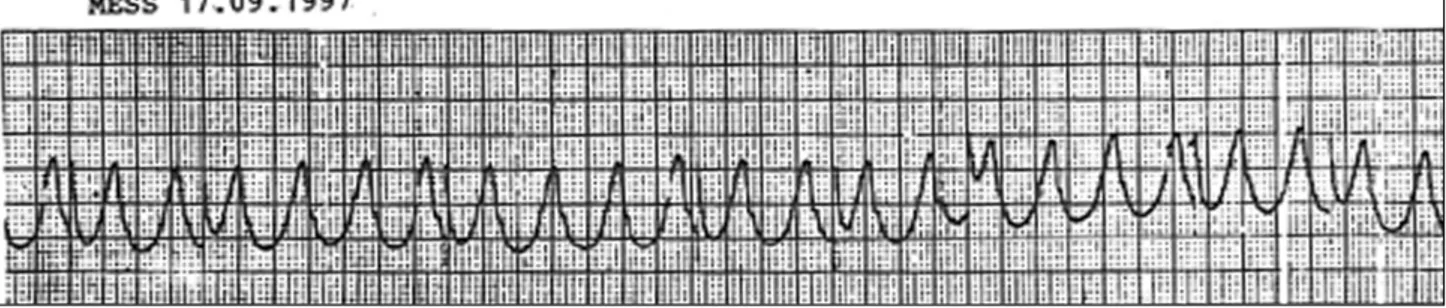 Fig. 2 – Eletrocardiograma: fibrilação atrial, eixo QRS indeterminado plano frontal e distúrbio de condução intraventricular do estímulo.