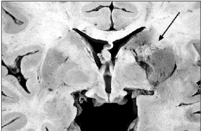 Fig. 3 - Visão do átrio esquerdo aberto e da valva mitral. Note o grande trombo preen- preen-chendo totalmente a aurícula esquerda (seta).