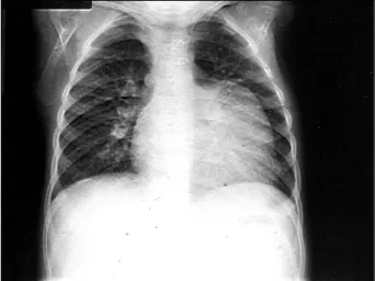 Fig. 1 - Radiografia de tórax salientando área cardíaca deformada na parte superior do arco inferior esquerdo por provável câmara ventricular direita rudimentar,  acompanha-da de vasculariacompanha-dade pulmonar diminuíacompanha-da na periferia de ambos os