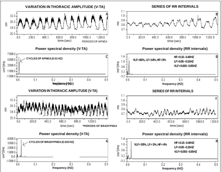 Table III – Analysis of the breathing pattern in group II in regard to functional parameters  * NB OB p N 27 15  -Age (years) 63.9 ± 13.0 55.2 ± 12.1 NS Sex (F/M) 11 / 16 2 / 13 NS FC III-IV (%) 63.2% 53.3% NS DM2 (%) 10.5% 20% NS EF (%) 25.1 ± 9.5 36.2 ± 