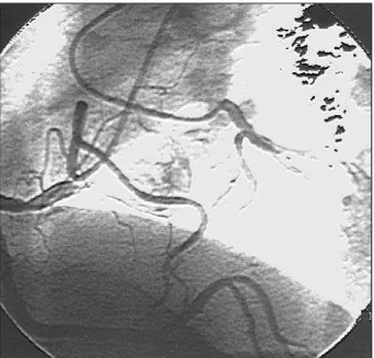 Fig. 1 – Right coronary artery with an eccentric 90% lesion in its initial third.