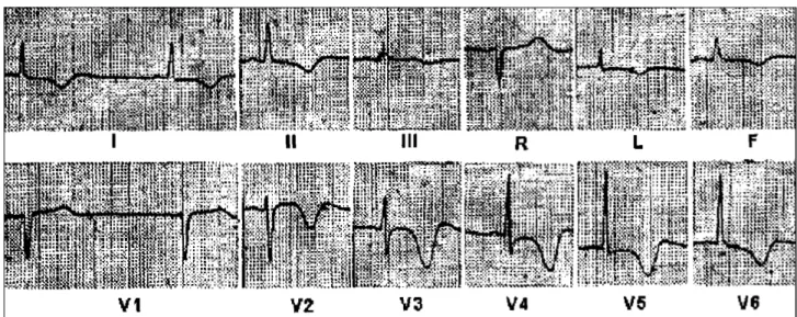 Fig. 1 - Electrocardiogram of patient with stroke. Observe sinus bradycardia, inverted T waves with wide bases (cerebral T wave), and prolonged QT interval.