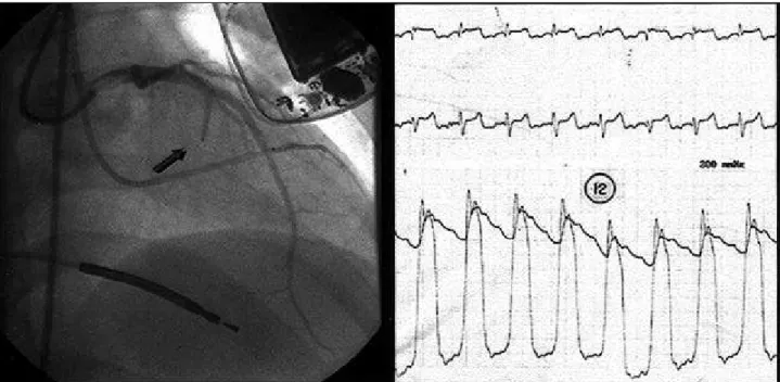 Fig. 3 – The last stage of the procedure. After alcohol infusion, amputation of the septal branch is seen on the left side, and nonexistence of pressure gradient on the right side.