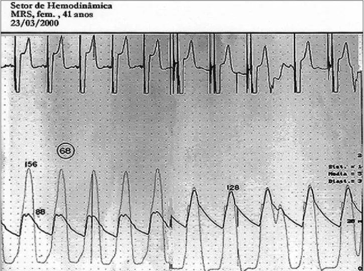 Fig. 4 - Pressure recording in a patient with definitive DDD-type pacemaker, before and after ablation with absolute alcohol