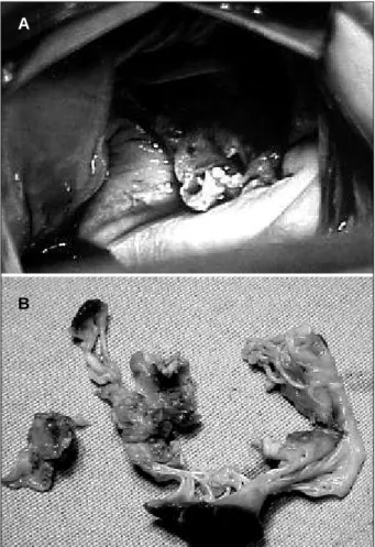 Fig. 2 – 2a) View of the mitral valve destroyed by vegetations during surgery; 2b) Excised mitral valve with alterations of infective endocarditis.
