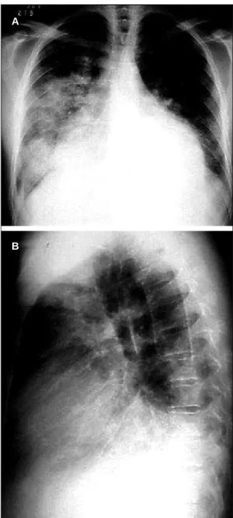 Fig. 3 – 3a, 3b) Active endocarditis in native aortic valve. Aortic insufficiency.