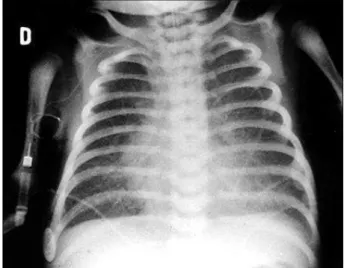 Fig. 1 - Radiografia de tórax mostra área cardíaca dentro de limites normais acompa- acompa-nhada de acentuada congestão venocapilar pulmonar.