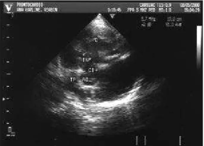 Fig. 2 – In the transverse view of the ventricles, a more marked septal hypertrophy is seen as compared with the posterior wall.
