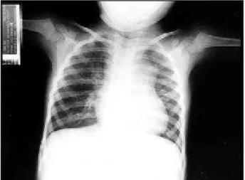 Fig. 1 - Radiografia de tórax mostra área cardíaca normal com ponta elevada, trama vascular pulmonar congesta e arco médio muito abaulado.