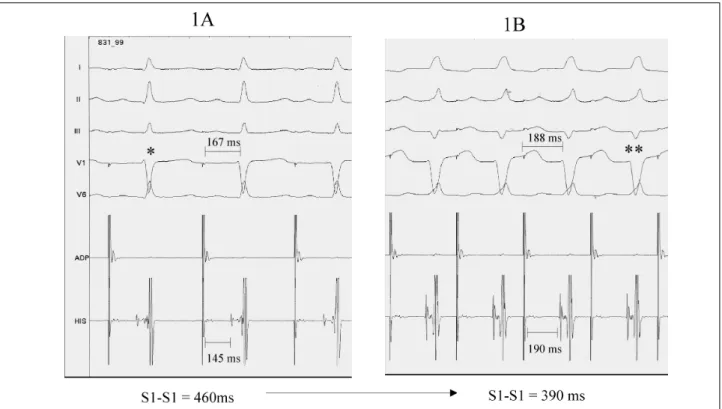 Fig. 1 – Continuous programmed stimulation in high right atrium showing: (1A) with a stimulation cycle (S1-S1) of 460 ms, mild ventricular preexcitation occurs (*); (1B) continuing the tracing, progressive ventricular preexcitation is observed during the s