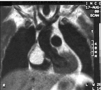 Fig. 3 - Appearance of the tumor after its resection.