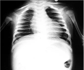 Fig. 1 - Radiografia de tórax mostra aumento da área cardíaca às custas do átrio direito e do ventrículo esquerdo com trama vascular pulmonar diminuída.