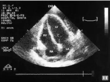 Fig. 1 - Transthoracic echocardiographic image of a voluminous pericardial effusion with septations and signs of cardiac tamponade