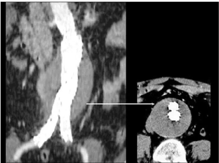 Fig. 1 - Abdominal CT scan with contrast showing the stent and an exclusion of the aneurysm.