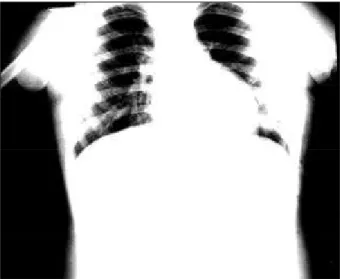 Fig. 1 - Radiografia de tórax mostra continuidade dos arcos esquerdos sendo retificado o superior e alongado o inferior, com discreto aumento da trama vascular pulmonar.