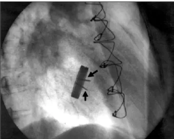 Fig. 1 - Radioscopy of the metallic double-disk prosthesis in the mitral position, prior to fibrinolysis