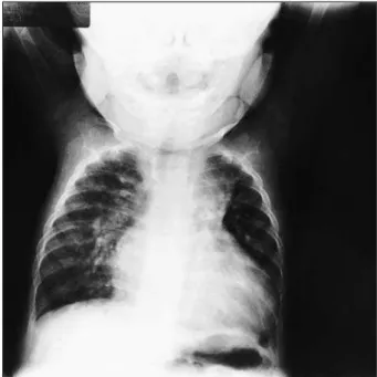 Fig. 1 - Radiografia de tórax salienta o aumento da área cardíaca e da trama vascular pulmonar com arco médio escavado