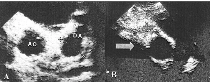 Fig. 1 - Echocardiogram, cross-sectional sections, performed 33 days after the beginning of Kawasaki disease, showing giant aneurysms 14 mm in diameter in the anterior interventricular artery (DA-A) and in the right coronary artery (CD-B), with an occlusiv