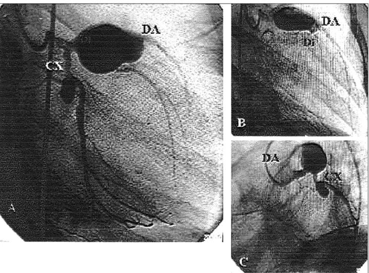 Fig. 3 – Coronary angiography performed 80 days after anti-inflammatory treatment showed a significant involution in the coronary aneurysms of the circumflex (CX), diagonal (Di), and distal part of the anterior interventricular (DA) arteries, in right (A, 