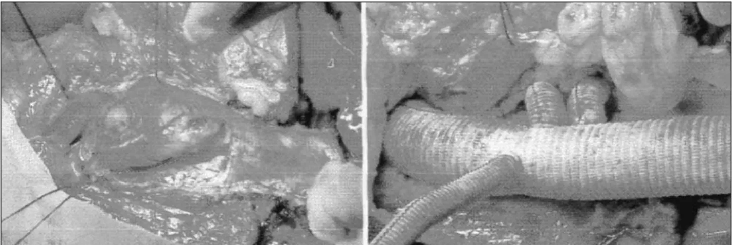 Fig. 2 – Intraoperative pictures A) open old Dacron graft- we can observe residual segment of the aorta with aneurysm dilation; B) ramified vascular graft used for reinsertion of abdominal vessels.