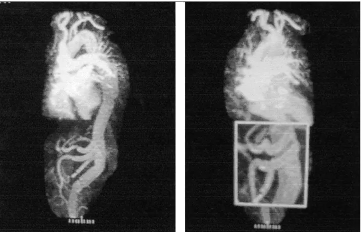 Fig.  3 – Total aortic magnetic resonance imaging performed on the 18th postoperative day