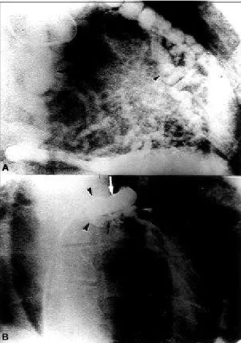 Fig. 1- A and B) Exercise (ex) and rest SPECT myocardial perfusion imaging with 99m Tc-sestamibi